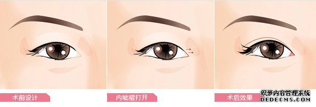 北京开眼角后的眼睛自然吗?