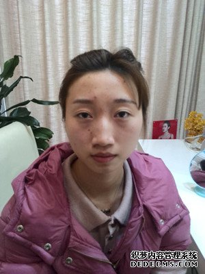 潍坊华美童艳梅医生做的面部脂肪填充,大家来看看效果怎么样