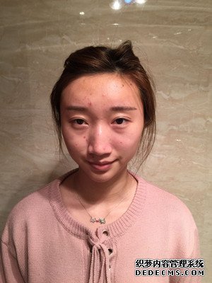 潍坊华美童艳梅医生做的面部脂肪填充,大家来看看效果怎么样
