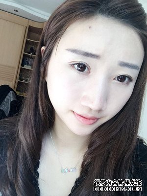 潍坊华美童艳梅医生做的面部脂肪填充,大家来看看效果怎么样