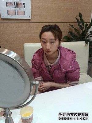 潍坊华美童艳梅医生做的面部脂肪填充,大家来看看效果怎么样