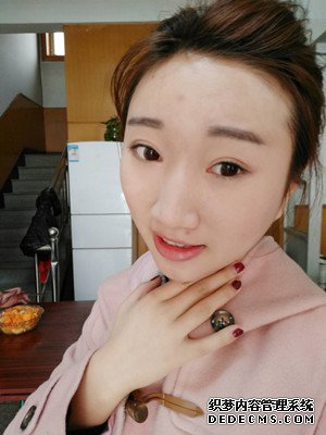 潍坊华美童艳梅医生做的面部脂肪填充,大家来看看效果怎么样