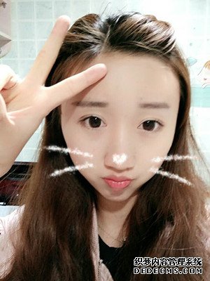 潍坊华美童艳梅医生做的面部脂肪填充,大家来看看效果怎么样