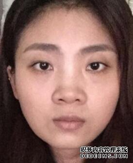 鼻子整形过程恢复图片,真实案例分享