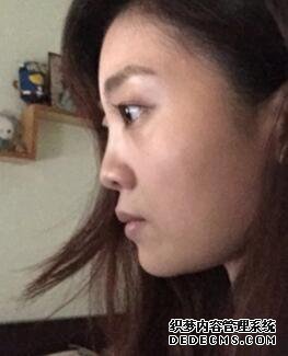 鼻子整形过程恢复图片,真实案例分享