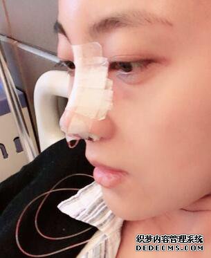 鼻子整形过程恢复图片,真实案例分享