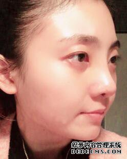 鼻子整形过程恢复图片,真实案例分享