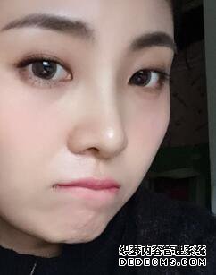 鼻子整形过程恢复图片,真实案例分享