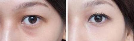 开眼角手术,一面是美一面是毁
