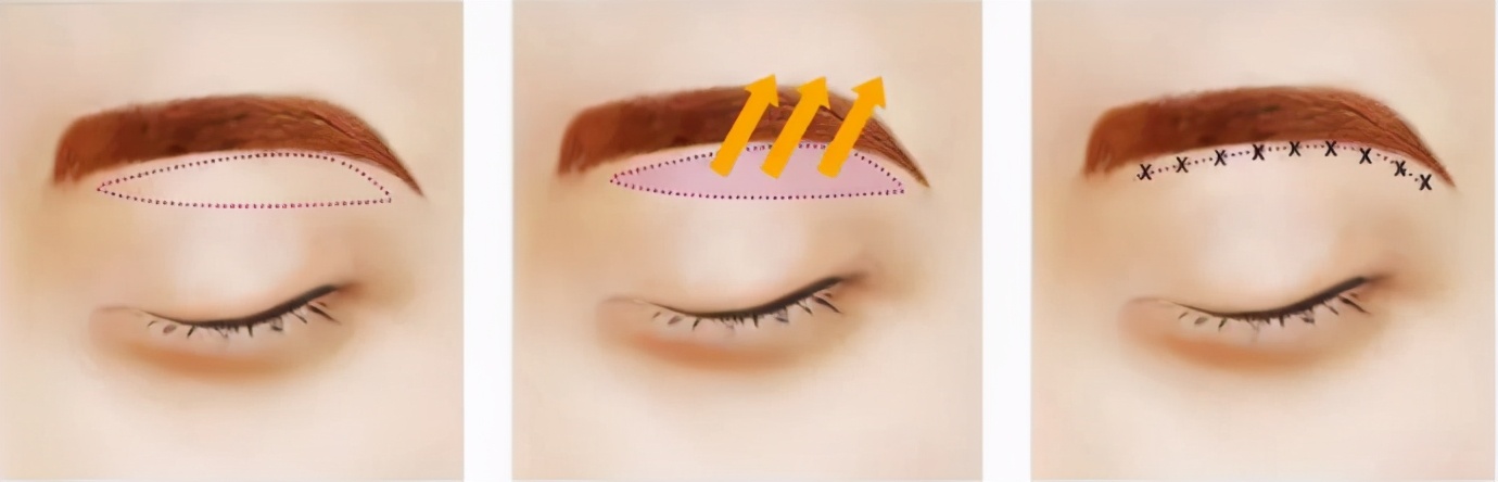 切眉or提眉哪个效果更好?