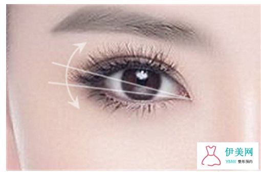 埋线双眼皮和切开双眼皮哪种方式好 埋线双眼皮和切开双眼皮哪种方式好