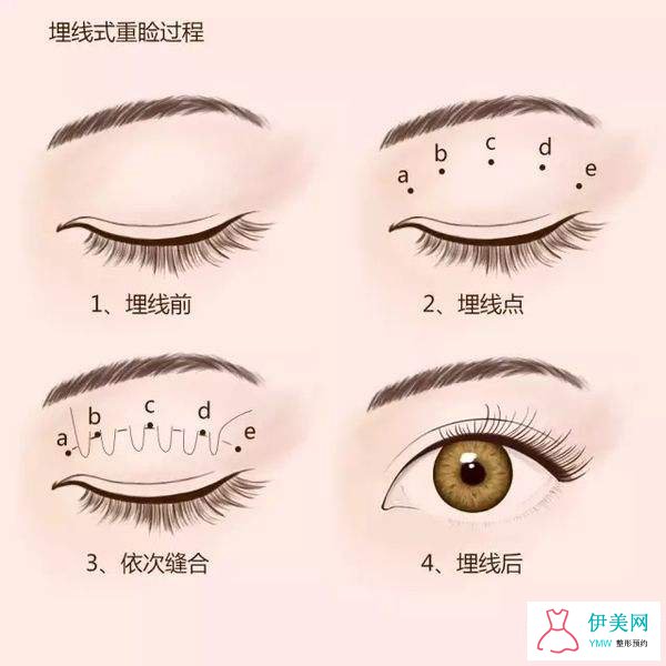 埋线双眼皮 埋线双眼皮