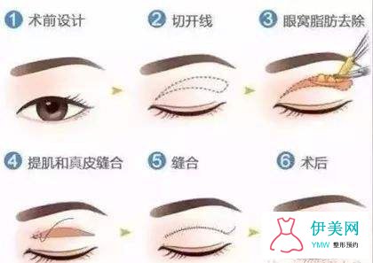 切开双眼皮 切开双眼皮