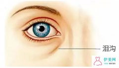 玻尿酸填充泪沟有什么好处