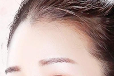 假体可以运用到丰额头手术中吗 假体可以运用到丰额头手术中吗