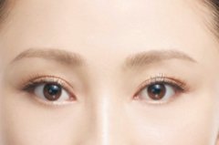 开眼角会慢慢缩短双眼皮吗
