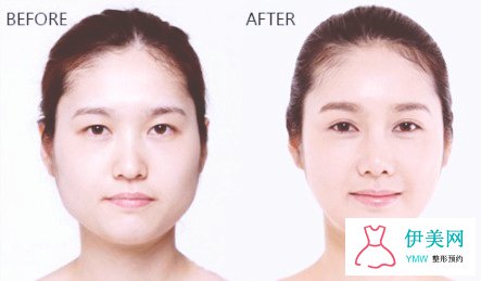 双眼皮手术后会留疤吗 双眼皮手术后会留疤吗