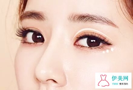 水肿眼睛可以做双眼皮吗 水肿眼睛可以做双眼皮吗