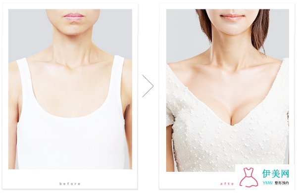 自体脂肪隆胸显得自然吗 自体脂肪隆胸显得自然吗