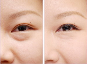 内吸去眼袋的持续时间 内吸去眼袋的持续时间