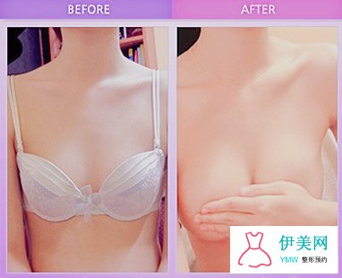 假体隆胸是否安全 假体隆胸是否安全