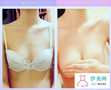 假体隆胸手术后的注意事项 假体隆胸手术后的注意事项