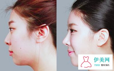 膨体隆鼻的感染率高吗 膨体隆鼻的感染率高吗