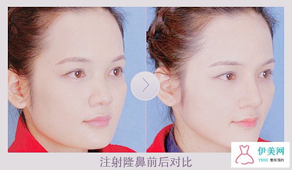 玻尿酸隆鼻有什么副作用吗 玻尿酸隆鼻有什么副作用吗