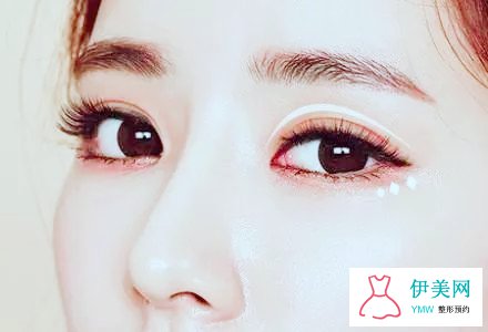 埋线双眼皮可以维持多久 埋线双眼皮可以维持多久