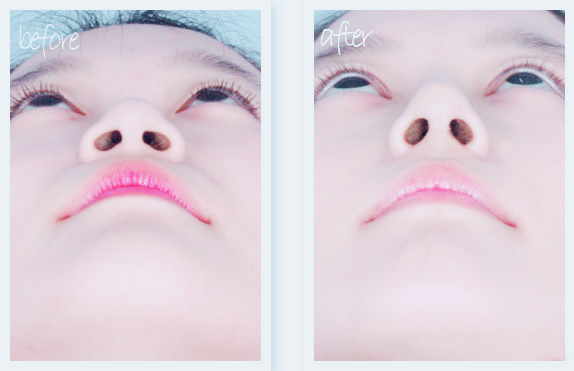 假体隆鼻修复手术效果怎么样 假体隆鼻修复手术效果怎么样