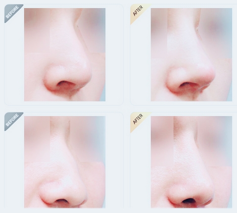 隆鼻修复手术安全吗 隆鼻修复手术安全吗