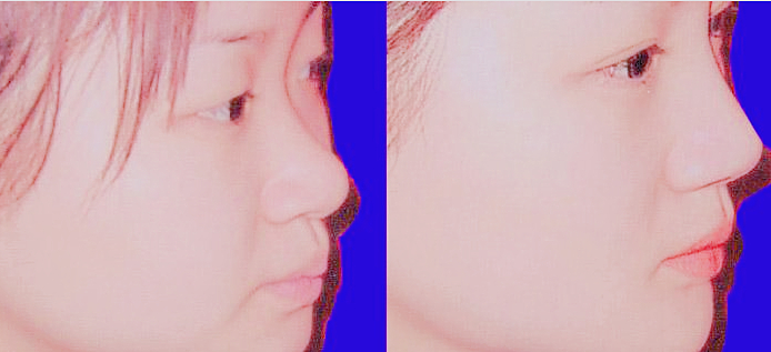 注射隆鼻手术如何选择医院 注射隆鼻手术如何选择医院