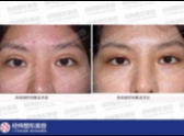 双眼皮修复到底难在那里