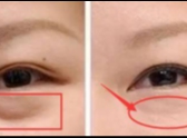 去眼袋失败,该如何修复