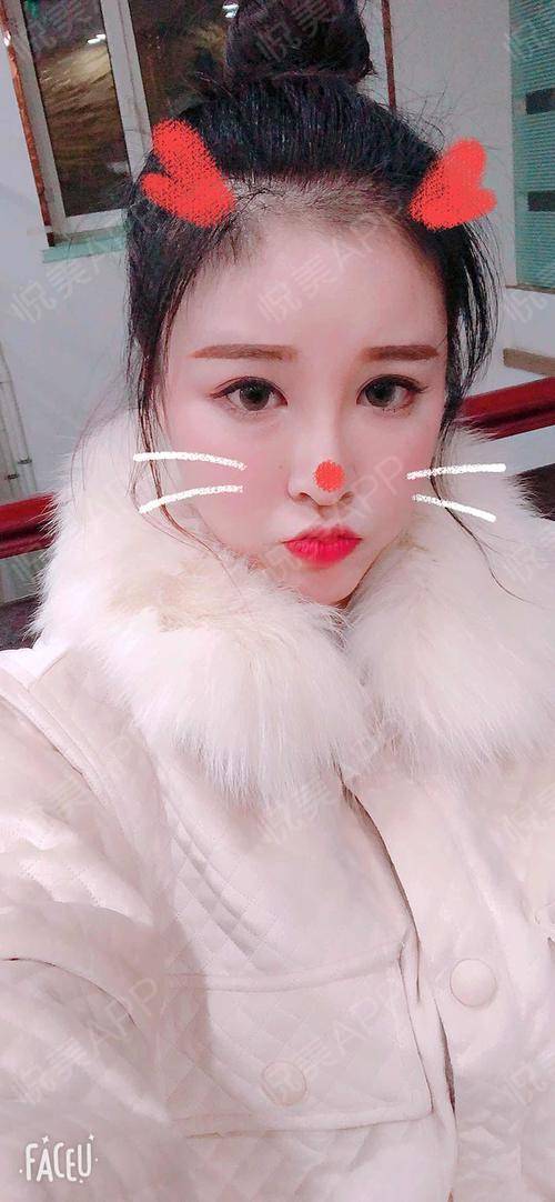 硅胶假体隆鼻术后143天_膨体假体隆鼻术后143天_鼻型矫正术后143天_隆鼻术后143天_鼻部术后143天_悦Mer_6804624808分享图片3