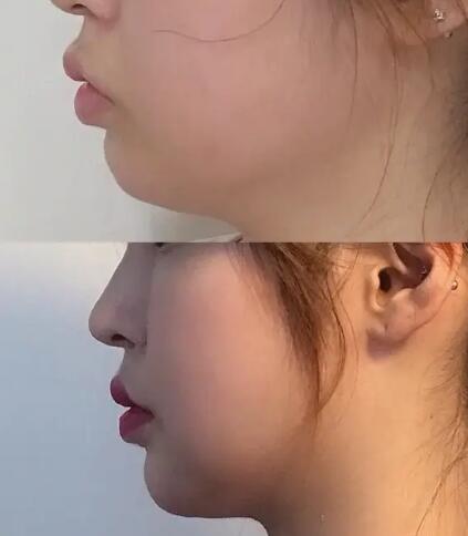 垫下巴变红变痒