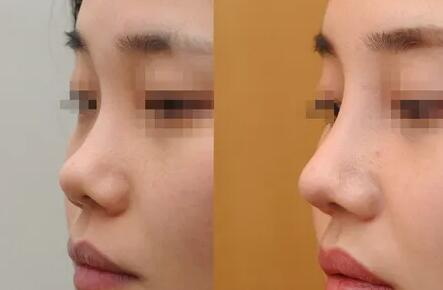 鼻子打玻尿酸可以维持多久