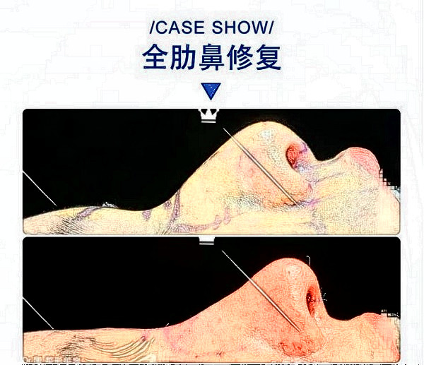华西医院卿勇全肋鼻修复案例图片(来源知乎)
