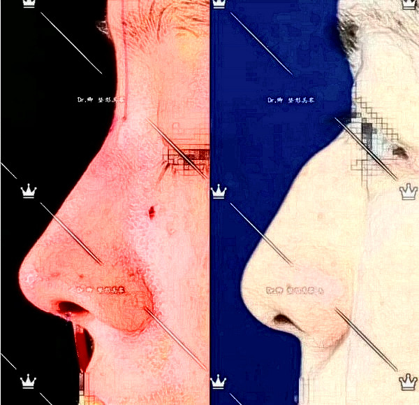 华西医院卿勇驼峰鼻矫正案例图片(来源知乎)